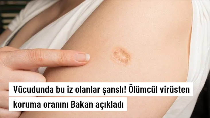 Vücudunda bu iz olanlar şanslı! Maymun çiçeği virüsünden koruma oranını Bakan açıkladı